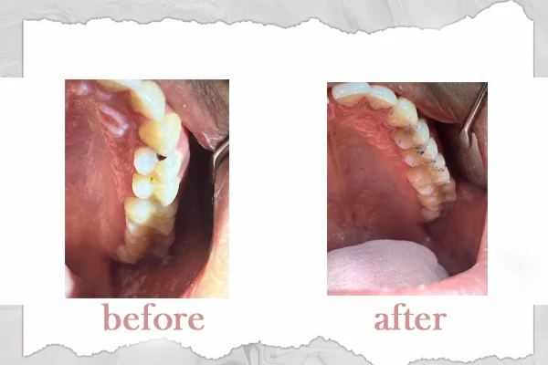 Before and After